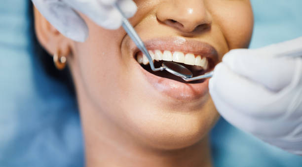 Best Emergency Wisdom Teeth Removal in St Helena, CA